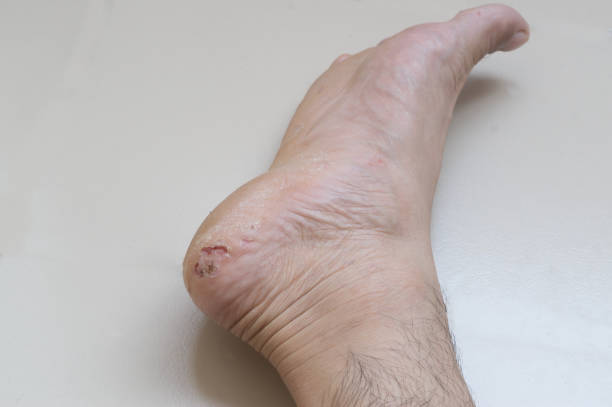 istock A foot with severe skin disease and itch 1124703051