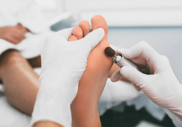 chiropodist removes hardened skin on the foot, using hardware. - podiatrist podiatry pedicure chiropodist imagens e fotografias de stock