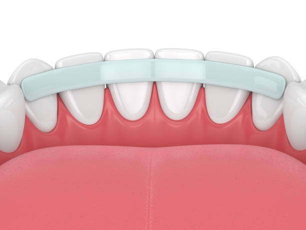 istock 3d render of  teeth with dental reinforcement fiber 1124723698