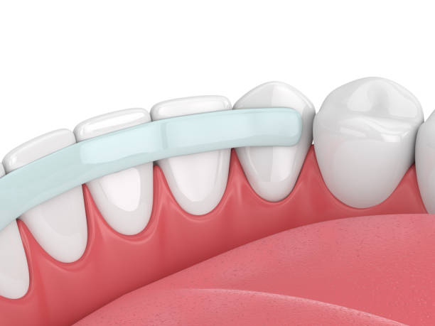 istock 3d render of  teeth with dental reinforcement fiber 1124723904