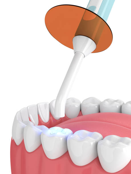 istock 3d render of jaw with dental polymerization lamp and light cured inlay 1124724332