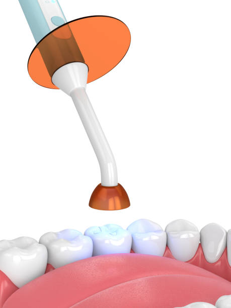 istock 3d render of jaw with dental polymerization lamp and light cured inlay 1124724334