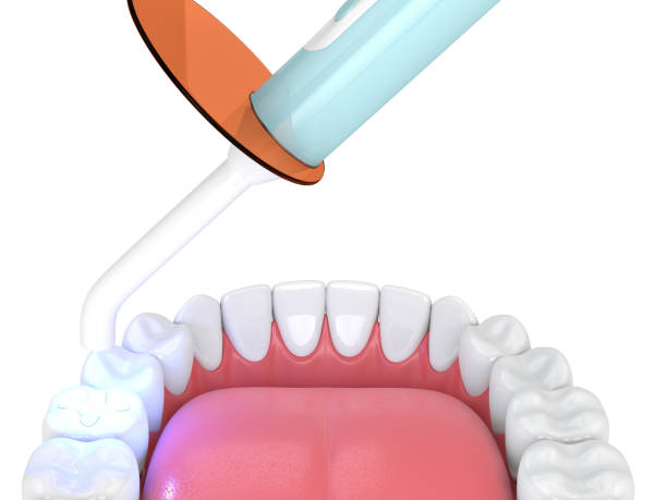 istock 3d render of jaw with dental polymerization lamp and light cured inlay 1124724335