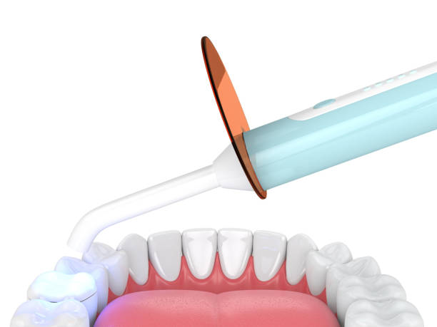 istock 3d render of jaw with dental polymerization lamp and light cured onlay 1124724656
