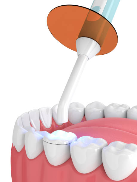 istock 3d render of jaw with dental polymerization lamp and light cured onlay 1124724657