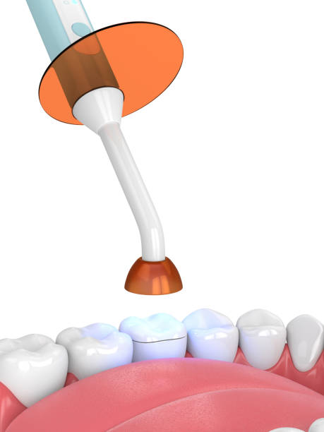 istock 3d render of jaw with dental polymerization lamp and light cured onlay 1124724658