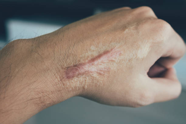 Scar on human skin keloid on hand. stock photo