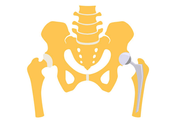 Total hip replacement Total hip replacement. Vector illustration. hip replacement stock illustrations