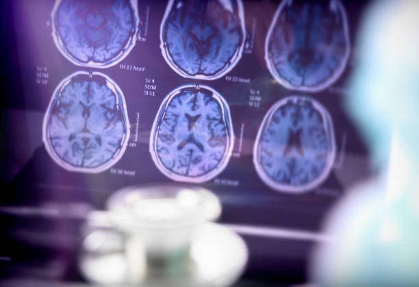 병원, 개념적 이미지에서에서 alzheimer의 질병의 과학적 분석 - 알츠하이머병 뉴스 사진 이미지
