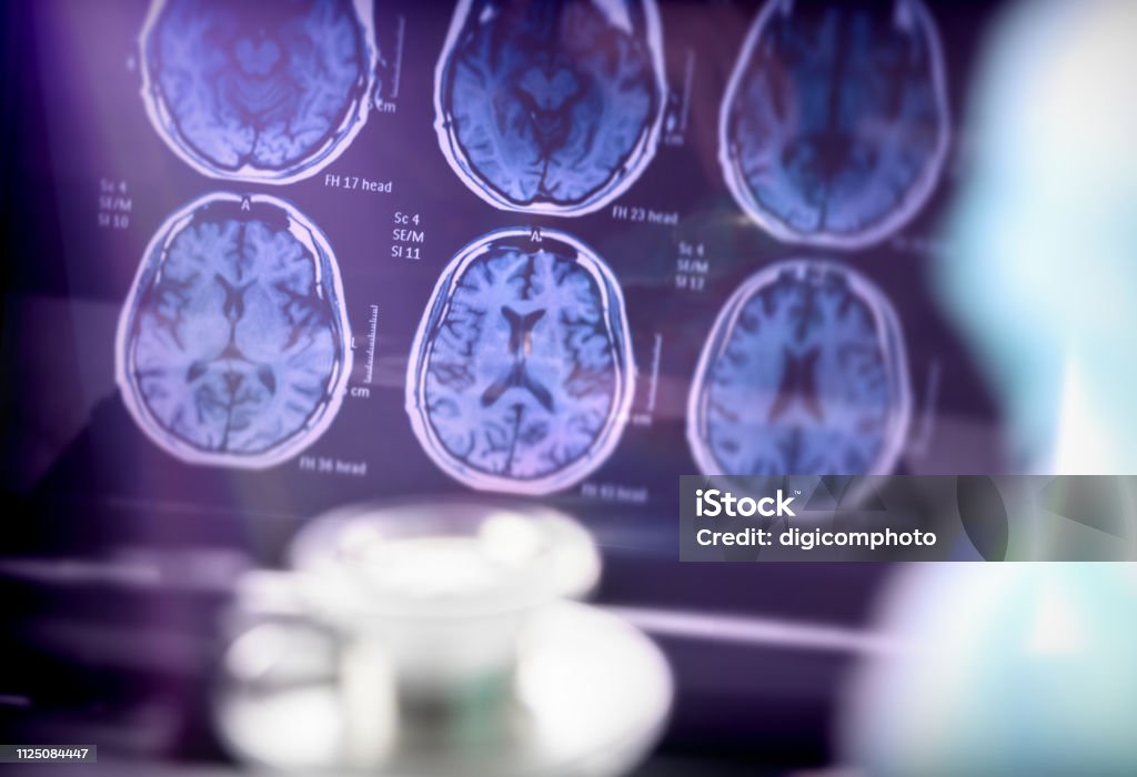 Scientific analysis of Alzheimer's disease in hospital, conceptual image Alzheimer's Disease Stock Photo