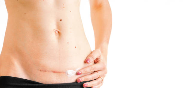 женщина живот со шрамом c кесарево исцеление крем медицины изолированных белый фон концепции - belly button стоковые фото и изображения