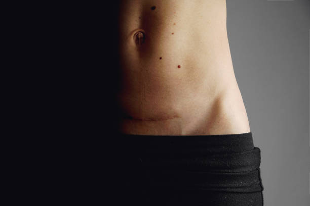 Closeup of woman belly with a scar from a cesarean section stock photo