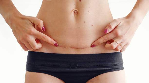 closeup del vientre de la mujer con una cicatriz de una cesárea - cesarean fotografías e imágenes de stock