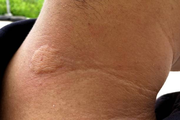 istock man neck after bee stings 1125237350