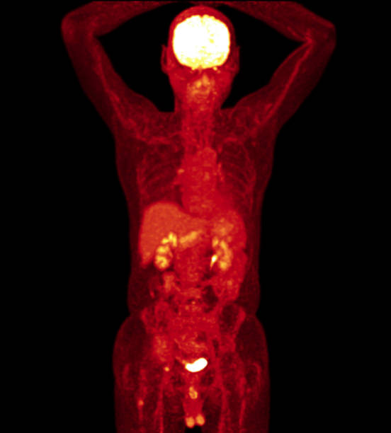 immagine pet scan di tutto il corpo piano coronale con tecnica mip. concetto di tecnologia medica. - pet foto e immagini stock