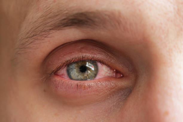istock red eye of a patient with human conjunctivitis 1125340489