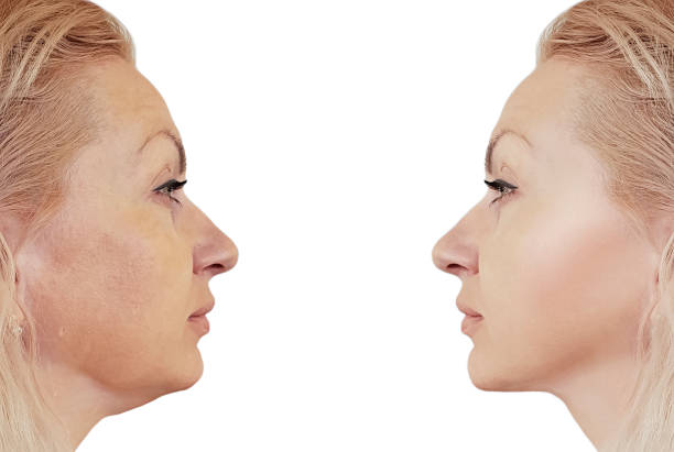 istock woman double chin before and after procedures, retouching 1125849338