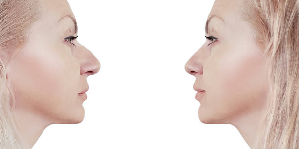 istock girl nose before and after correction 1125868650
