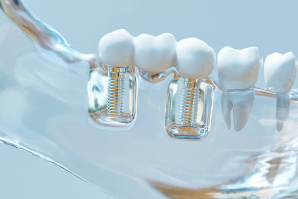 diente implante humano - 3d rendering - artificial metal healthcare and medicine technology fotografías e imágenes de stock