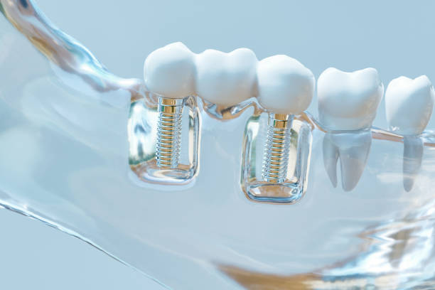 impianto umano dentale - rendering 3d - dental treatment foto e immagini stock