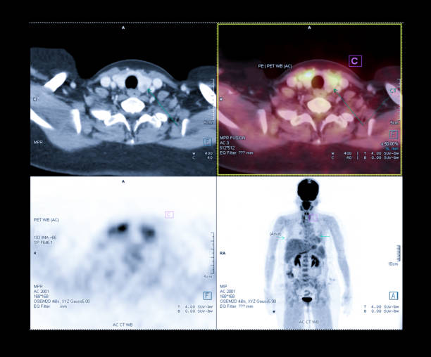 istock PET Scan image of the neck or thyroid gland Comparison CT scan image vs PET CT for detect cancer. 1125918561