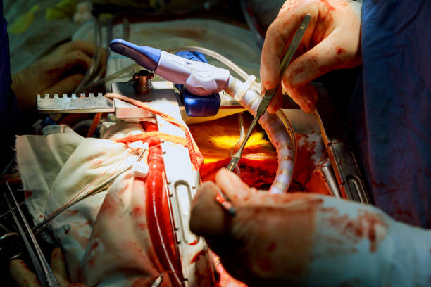 심장 수술입니다. 오픈 심장 수술 봉합 큰 saphenous 정 맥 - human artery animal artery human heart blood 뉴스 사진 이미지