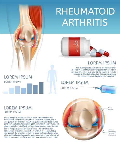 инфографика метод лечения ревматоидного артрита - color enhanced stock illustrations
