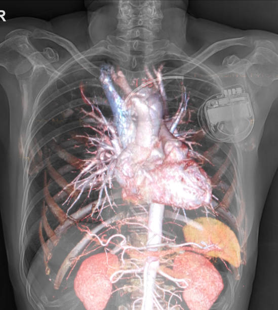 istock Medical chest x-ray with AICD pacemaker background. 1126011825