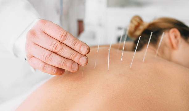 Woman having acupuncture treatment on her back Acupuncturist inserting a needle into a female back. patient having traditional Chinese treatment using needles to restore an energy flow through specific points on the skin. acupuncture photos stock pictures, royalty-free photos & images