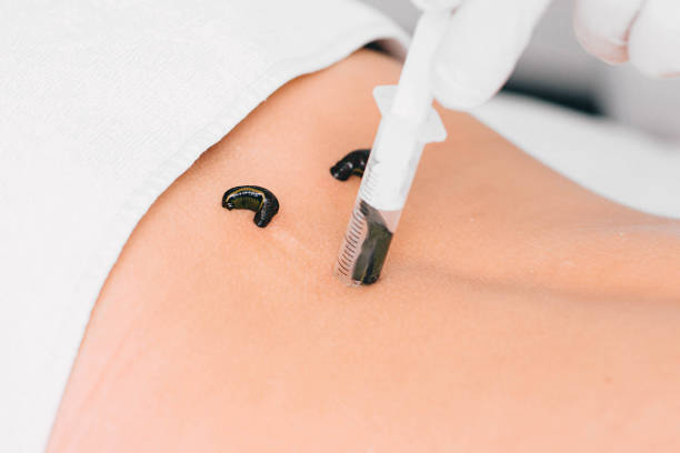 istock patient during leech therapy, alternative Hirudotherapy, blood purification 1126093127
