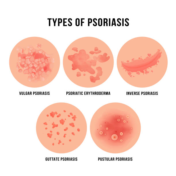 Psoriasis skin disease, types of derma problem Psoriasis skin disease, types of derma problem. Skin disease marked by red, itchy, scaly patches. Vector flat style cartoon illustration isolated on white background psoriasis stock illustrations