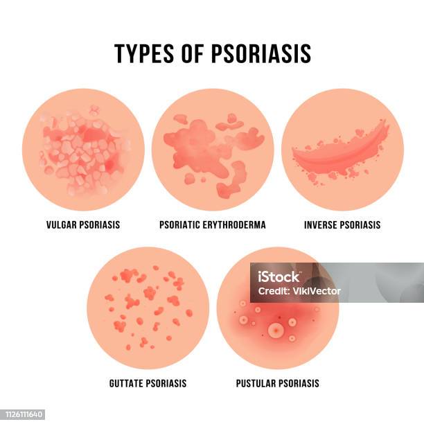 Psoriasis Skin Disease Types Of Derma Problem Stock Illustration - Download Image Now - Psoriasis, Skin, Skin Condition