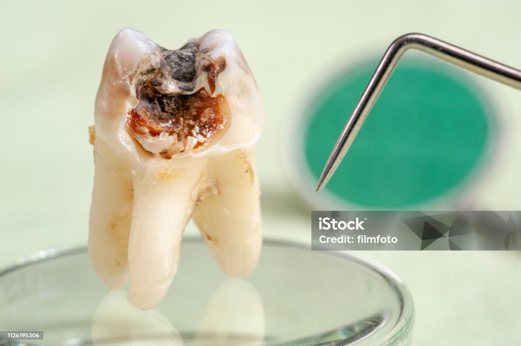 齲蝕とアマルガム臼歯を抽出 - 歯科用機器のロイヤリティフリーストックフォト