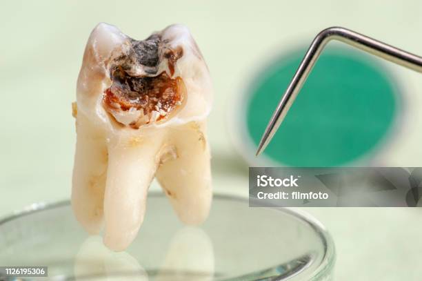 齲蝕とアマルガム臼歯を抽出 - 歯科用機器のストックフォトや画像を多数ご用意 - 歯科用機器, 歯科衛生, 取り除く
