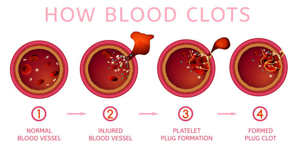 Blood Clotting Process Stock Illustration - Download Image Now - Blood Clot,  Platelet, Clogged - iStock