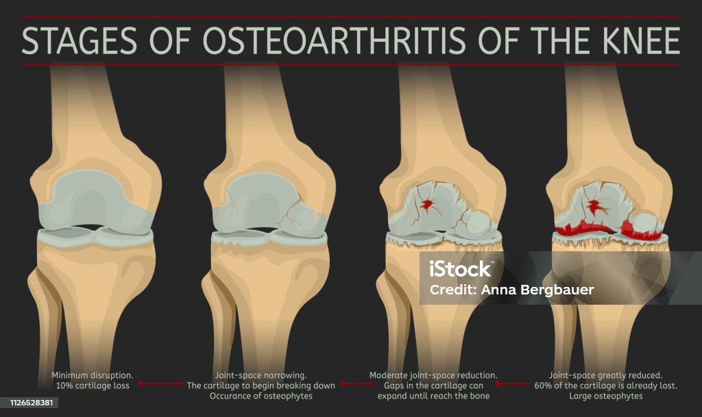 Stages of osteoarthritis of the knee Stages of osteoarthritis of the knee. Editable vector illustration in realistic style isolated on a dark grey background. Medical, healthcare and physiology concept. Scientific infographic. Osteoarthritis stock vector