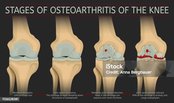 Stages Of Osteoarthritis Of The Knee Stock Illustration - Download Image Now - Osteoarthritis, Knee, Cartilage