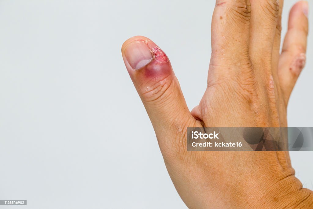 Paronychia, ngón tay sưng với viêm móng tay do nhiễm trùng do vi khuẩn trên bàn tay trẻ mới biết đi. - Trả phí Bản quyền Một lần Bệnh truyền nhiễm Bức ảnh sẵn có Paronychia, ngón tay sưng với viêm móng tay do nhiễm trùng do vi khuẩn trên bàn tay trẻ mới biết đi. - Trả phí Bản quyền Một lần Bệnh truyền nhiễm Bức ảnh sẵn có