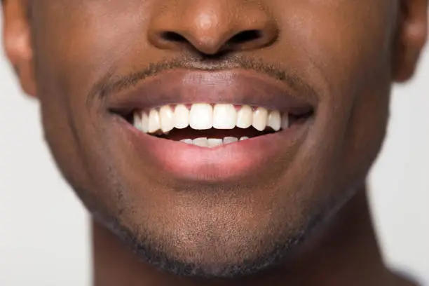 Close up view of beaming orthodontic white wide male smile, african black man with healthy straight clean teeth isolated on grey studio blank background, tooth health care whitening dentistry concept