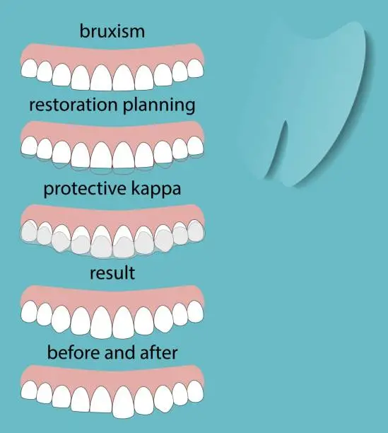 Vector illustration of Layout attrition Bruxism teeth illustration vector. Erased teeth. Restoration of teeth. Protective kappa. Dental concept.