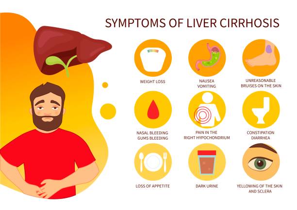 ilustrações, clipart, desenhos animados e ícones de cartaz de vetor de sintomas de cirrose hepática. - yellowing