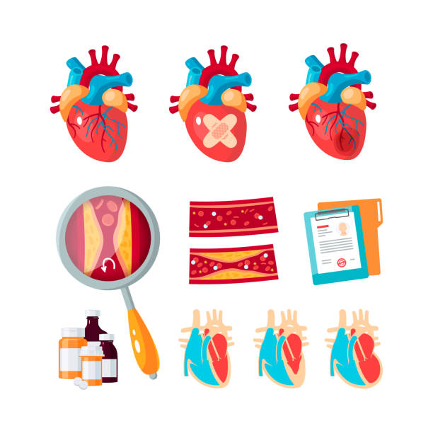 380+ Cartoon Of Coronary Artery Disease Stock Illustrations, Royalty