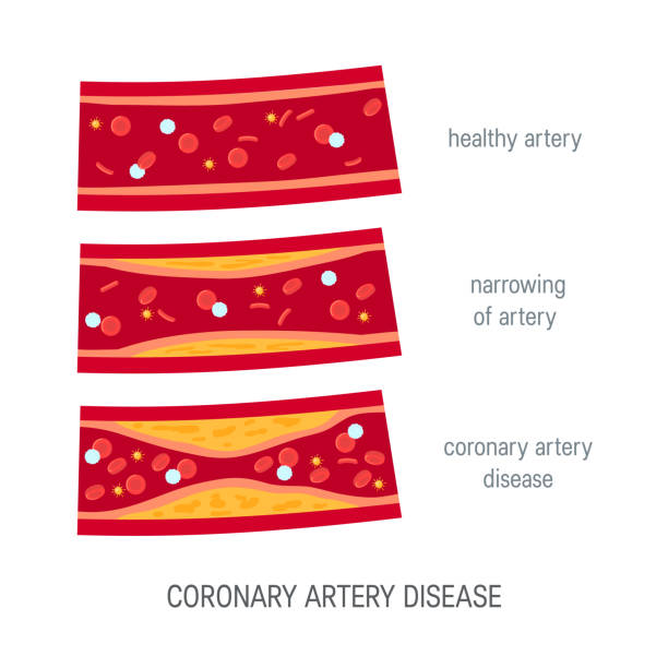 illustrazioni stock, clip art, cartoni animati e icone di tendenza di concetto di malattia coronarica in stile piatto - human artery cholesterol atherosclerosis human heart