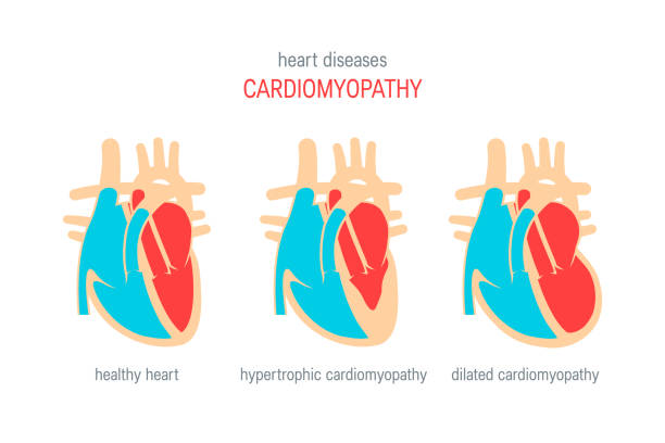 Heart disease vector concept in flat style Cardiomyopathy disease concept. Vector illustration for articles, education textbooks, infographics etc. in flat style dilation stock illustrations