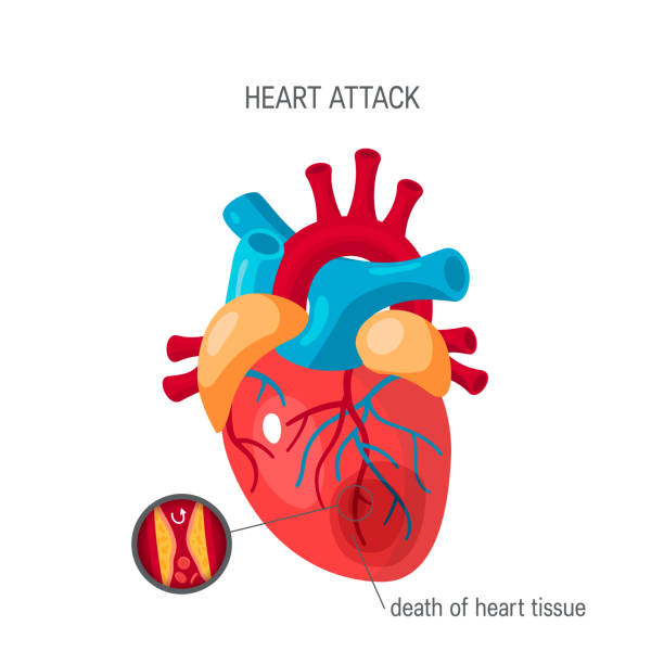 illustrazioni stock, clip art, cartoni animati e icone di tendenza di concetto di infarto in stile piatto, vettore - human artery cholesterol atherosclerosis human heart