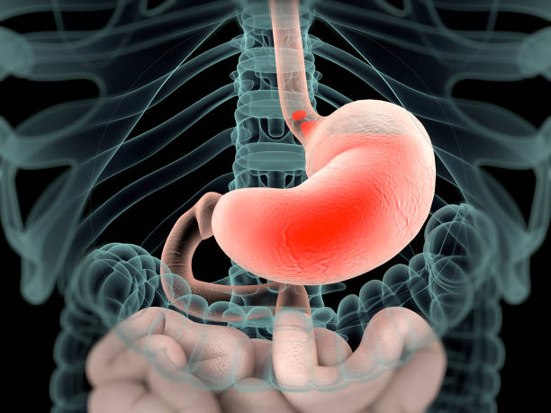 istock Acid reflux shown in xray view of intestines. 1126835930