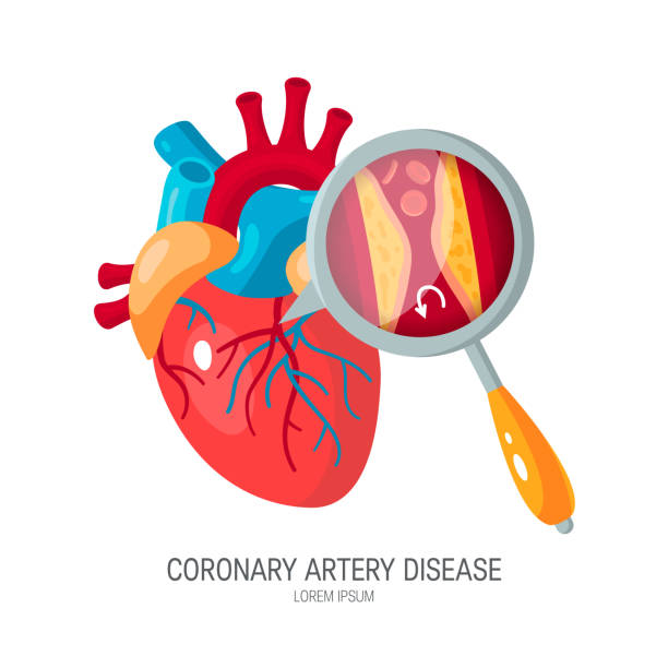 koncepcja choroby wieńcowej w stylu płaskim - human artery cholesterol atherosclerosis human heart stock illustrations