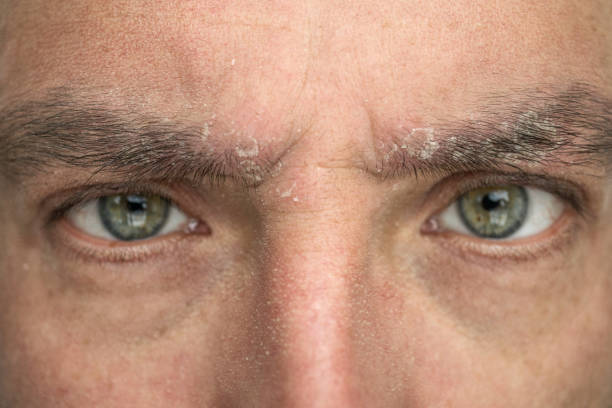 istock psoriasis on the eyebrow close up, dermatological diseases, skin problems 1127052062