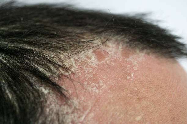 psoriasis sur la racine des cheveux et le cuir chevelu-de près, des maladies dermatologiques, des problèmes de peau - human scalp photos et images de collection