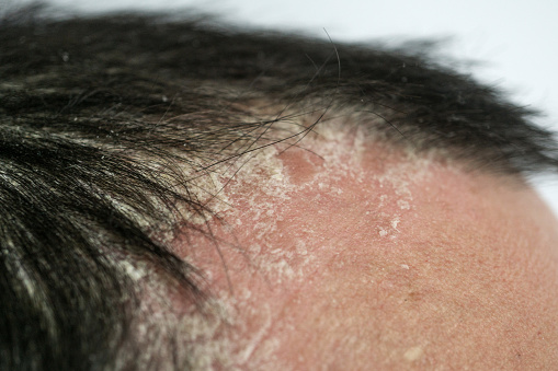 psoriasis on the hairline and on the scalp-close up, dermatological diseases, skin problems.